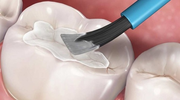 Vật liệu trám răng bằng GIC