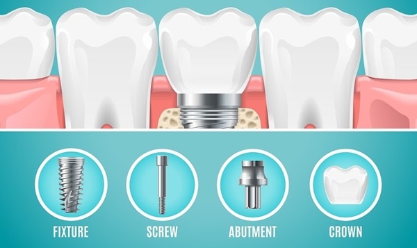 Cấy ghép răng bằng vật liệu implant